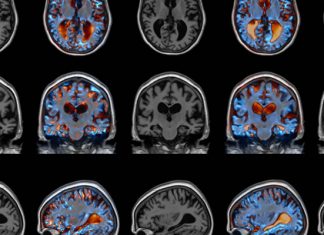 Cambios de comportamiento puede ser indicios de la aparición de la demencia