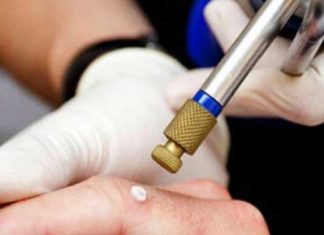 Hemangioma cereza: todo lo que necesitas saber