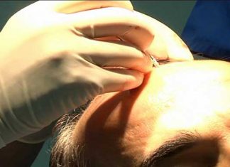 Causas de la calvicie y del pelo canoso identificadas