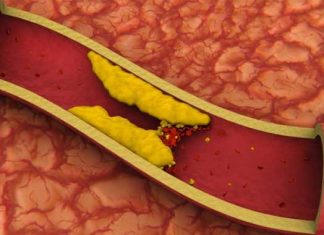 Alimentos que se deben evitar con el colesterol alto