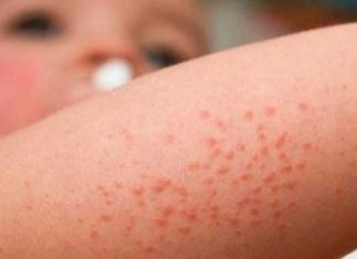 Científicos encuentran bases genéticas para el eccema