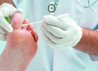 Infecciones por hongos: Tipos y tratamiento