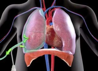 Neumotórax: Causas, síntomas y tratamiento
