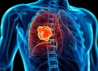 Un nuevo hallazgo podría «pausar y rebobinar» el cáncer de pulmón