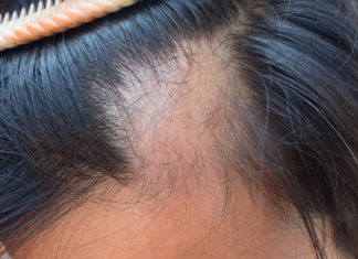 Fármaco experimental revierte la pérdida de cabello y el daño de la piel