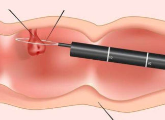 Aumento del cáncer colorrectal en adultos jóvenes: ¿Cuál podría ser la causa?