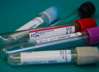 Detectado Alzheimer con un análisis de sangre